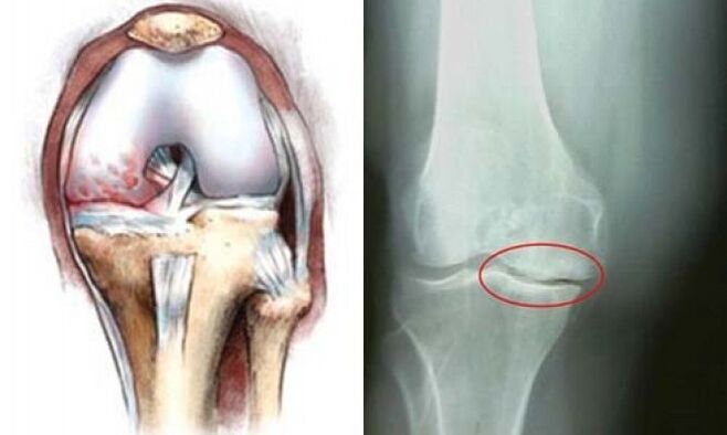artrosis de la radiografía de la rodilla
