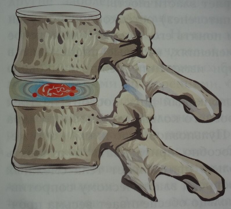 Daño al núcleo pulposo del disco intervertebral en la primera etapa de la osteocondrosis cervical. 
