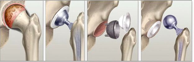 artroplastia de cadera por artrosis