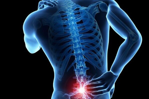 El dolor lumbar agudo es un síntoma del desplazamiento de los discos intervertebrales
