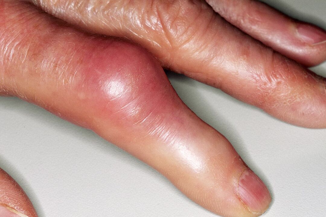 Hinchazón, deformación de la articulación del dedo y dolor agudo después de una lesión. 