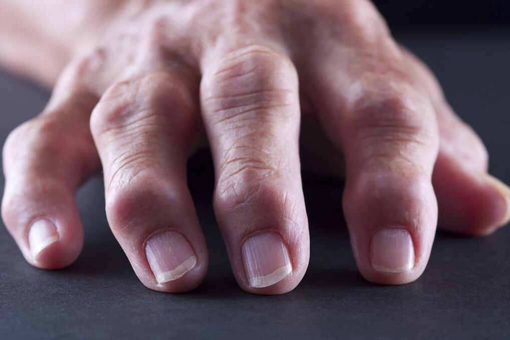 La bursitis se caracteriza por dolor, inflamación e hinchazón de las articulaciones de los dedos. 