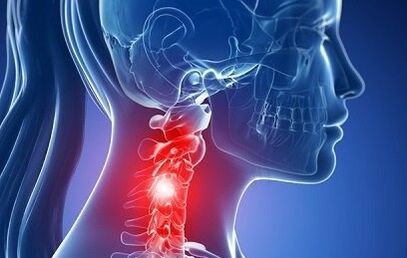 Osteocondrosis del cuello