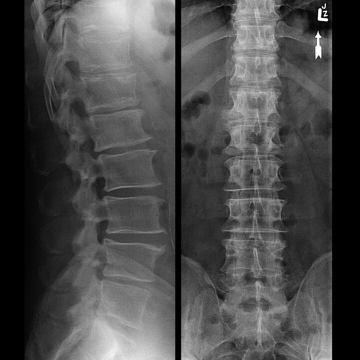 Sncing de la columna con osteocondrosis