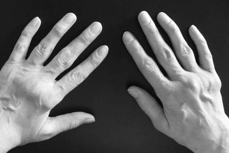 Síntomas de artritis en las articulaciones de las manos.