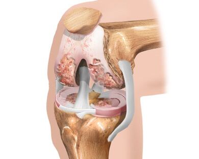 Destrucción de la articulación de la rodilla debido a artrosis.