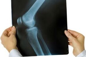 artrosis de la articulación de la rodilla en radiografía