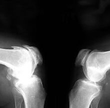 Artrosis en radiografía