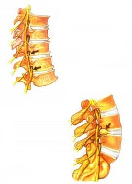ilustración de la osteocondrosis espinal