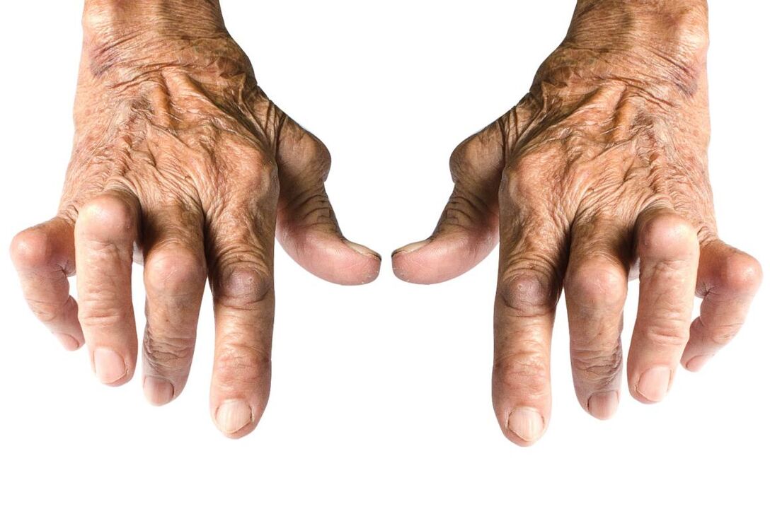 signos de artritis - deformidad articular